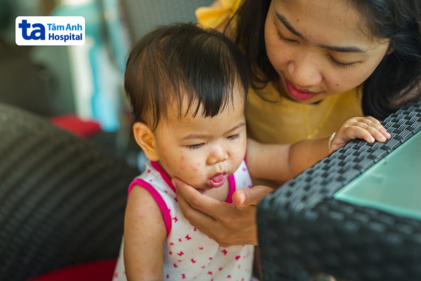 Sởi ở trẻ dưới 1 tuổi cần được phát hiện và điều trị đúng cách
