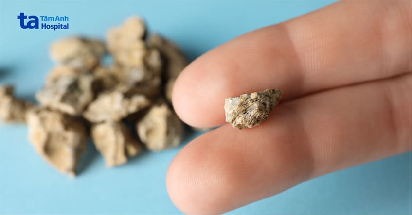 Sỏi tiết niệu có thể gây khó khăn trong việc điều trị viêm bàng quang