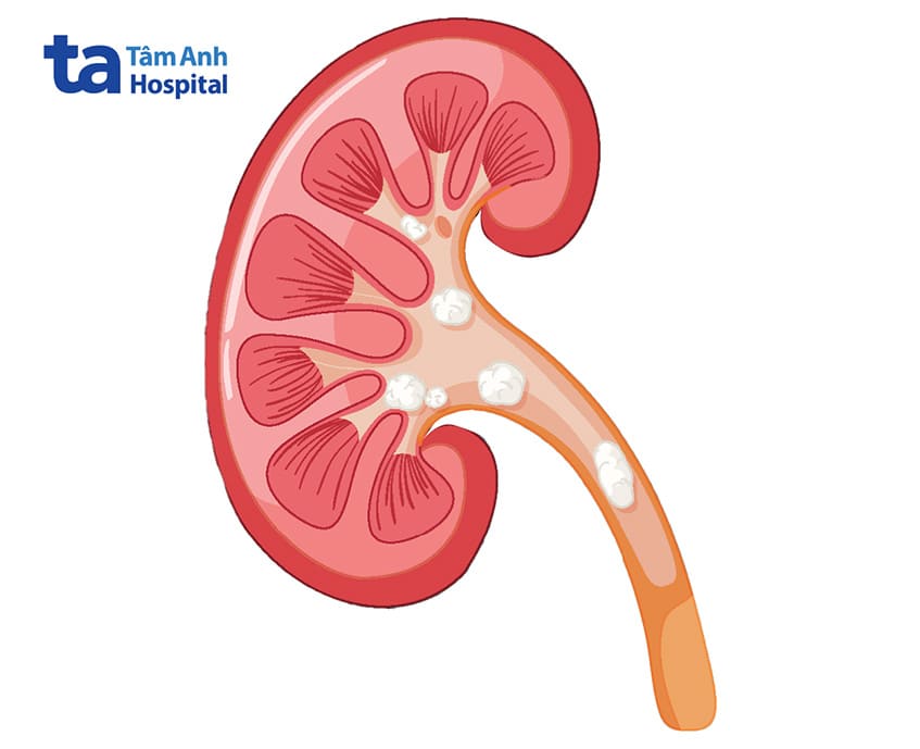 Sỏi và sạn có gai làm trầy xước niêm mạc khiến quan hệ xong đi tiểu ra máu