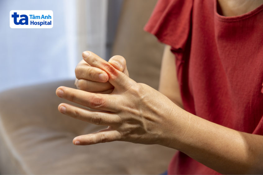 Sưng các khớp ngón tay có thể là biểu hiện bệnh viêm khớp