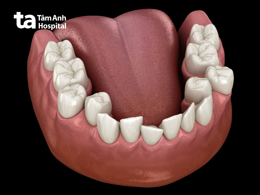 Tác hại của việc hàn răng sai cách