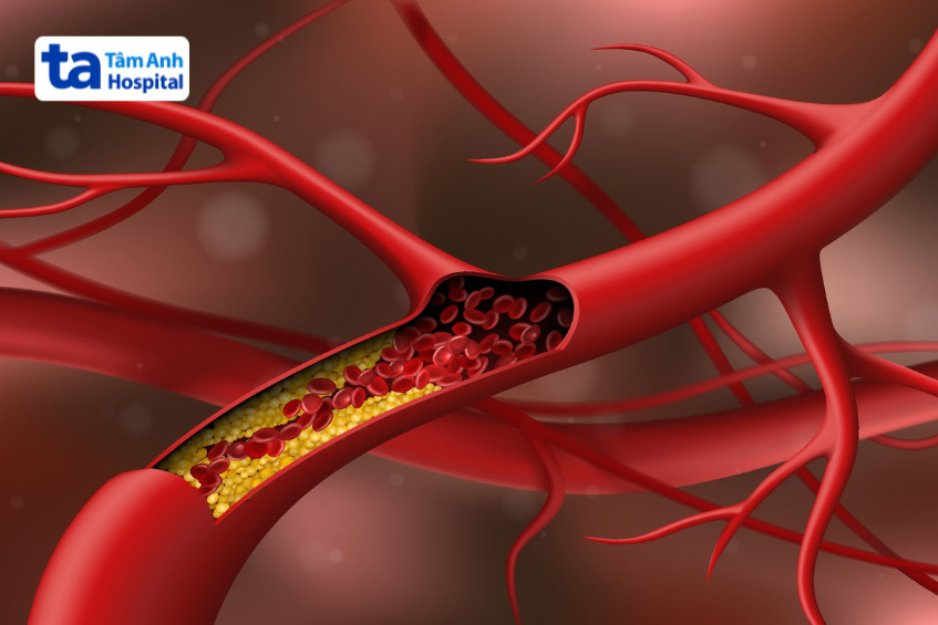 Tăng lipid máu có thể tạo nên các mảng xơ vữa gây tắc nghẽn mạch máu