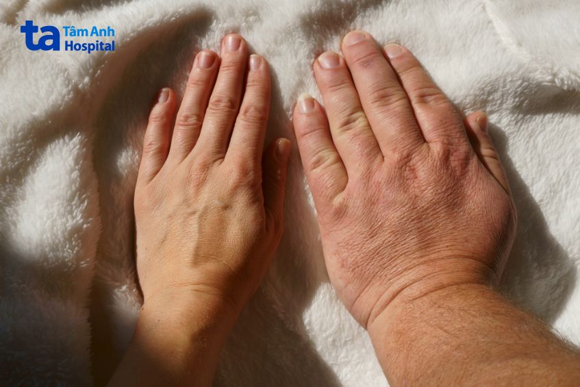 Tay của người mắc bệnh to đầu chi