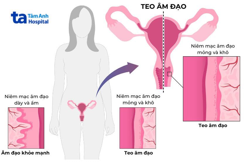 Teo âm đạo là bệnh lý phổ biến ở phụ nữ trong giai đoạn mãn kinh