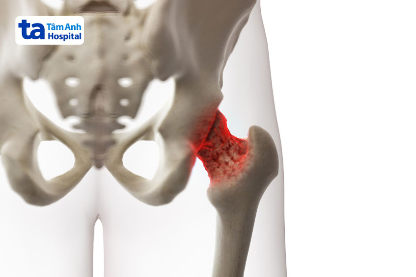 Thoái hóa khớp háng là bệnh phổ biến ở người già