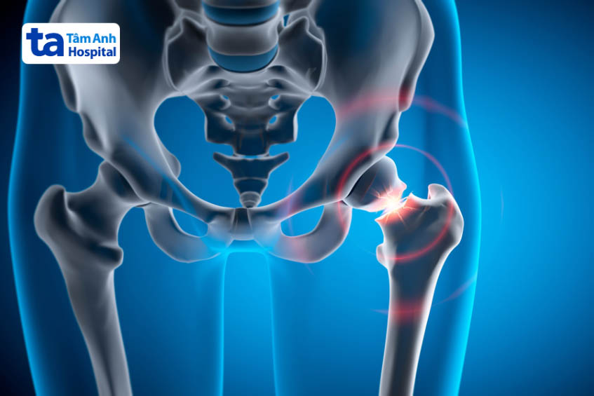 Thoái hóa khớp háng mang tính di truyền