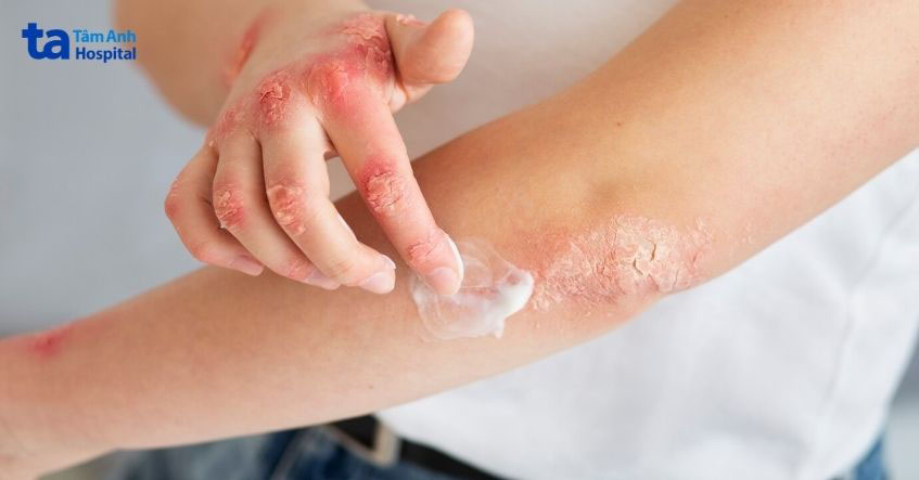 Thuốc bôi điều trị nấm da