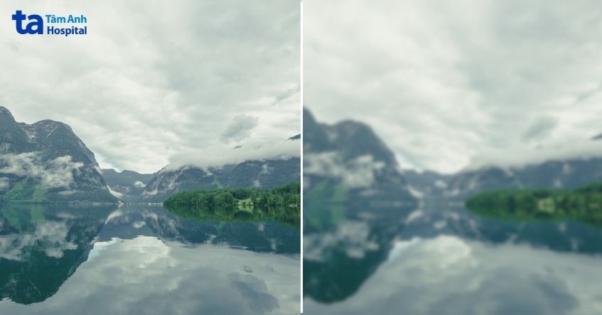 tình trạng đục thủy tinh thể ở người trẻ tuổi