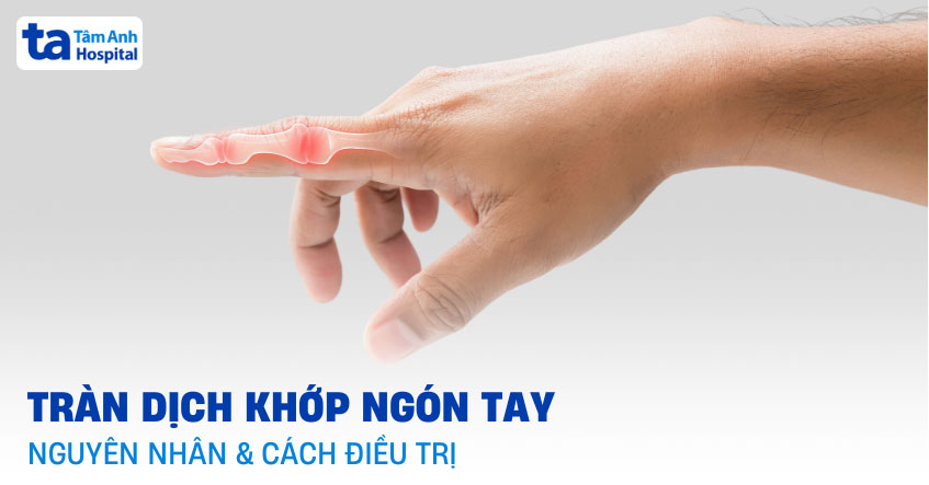 Tràn dịch khớp ngón tay: Nguyên nhân, triệu chứng và cách điều trị