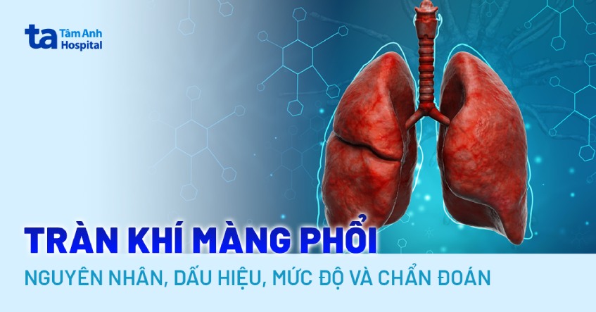 Tràn khí màng phổi: Nguyên nhân, dấu hiệu, mức độ và chẩn đoán