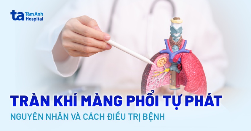 Tràn khí màng phổi tự phát: Nguyên nhân và cách điều trị bệnh
