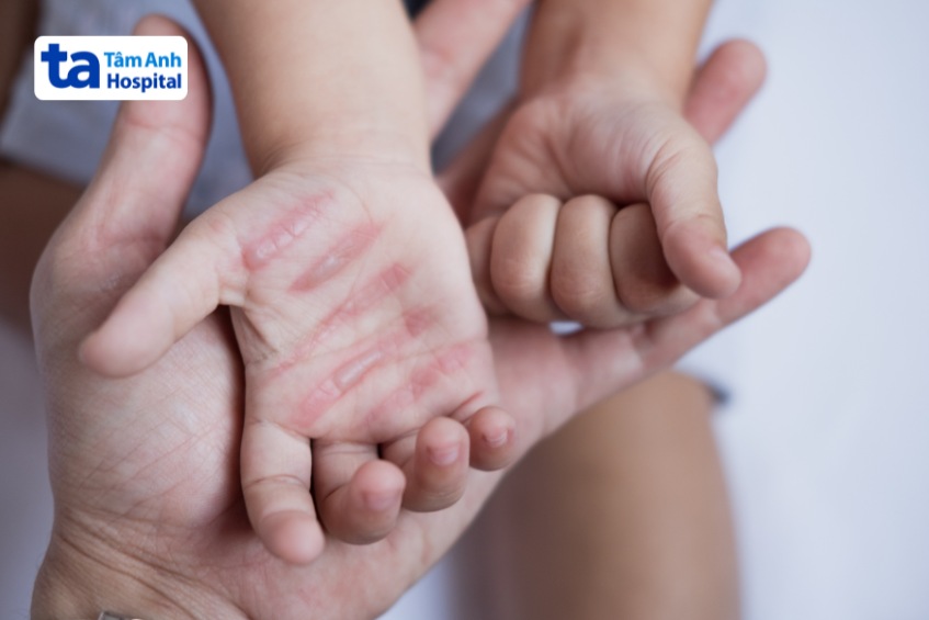 Tránh làm vỡ vết phồng rộp tại vùng da bị bỏng