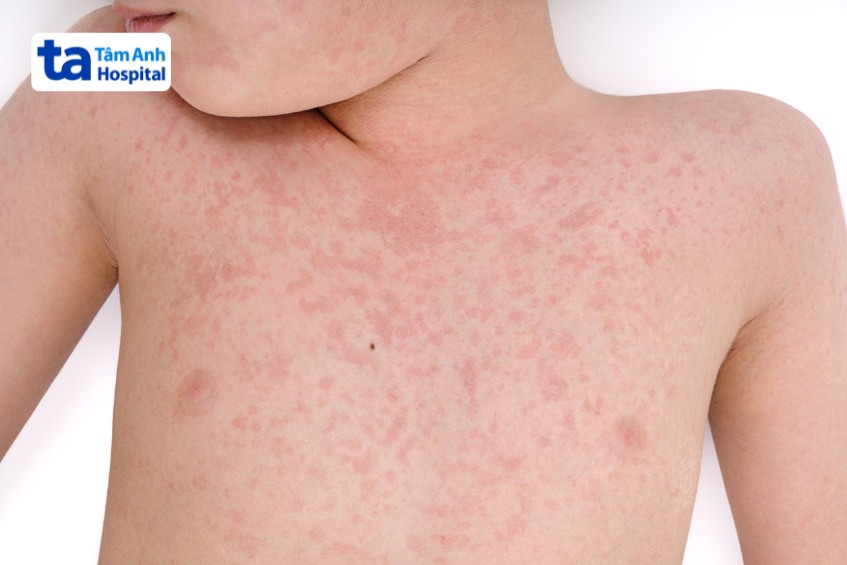 Trẻ bị sởi phát ban đỏ toàn thân