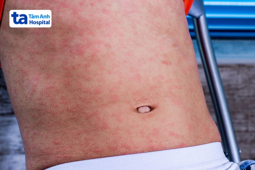 Trẻ bị sởi phát ban hồng toàn thân