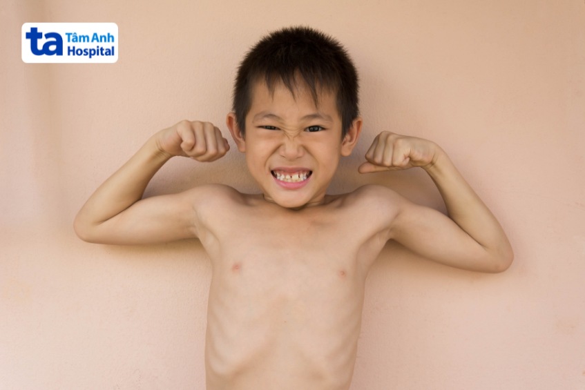Trẻ bị thiếu cân, còi xương do thiếu hụt dinh dưỡng