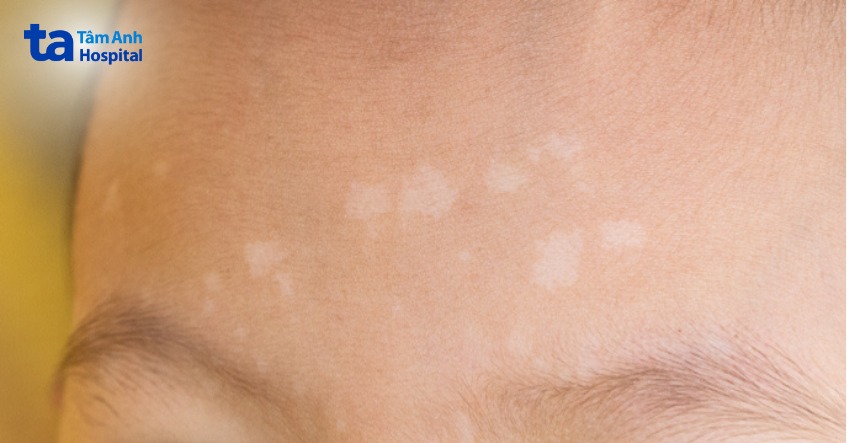 trẻ em rất dễ nhiễm nấm da mặt