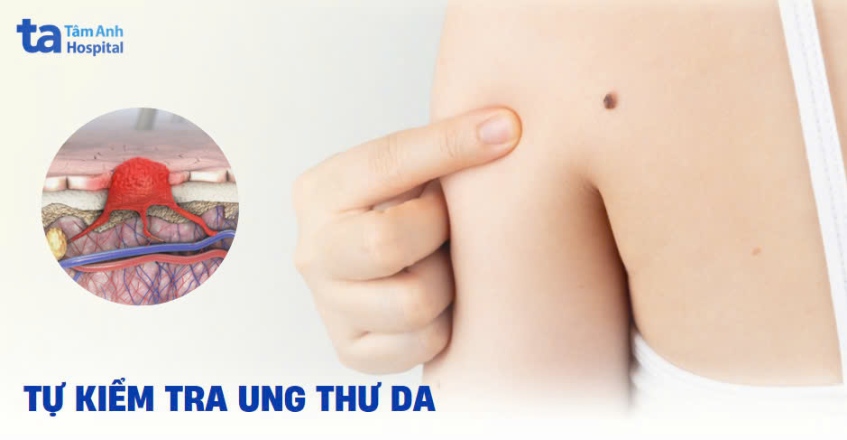 Cách tự kiểm tra ung thư da như thế nào? Có dễ nhận biết không?