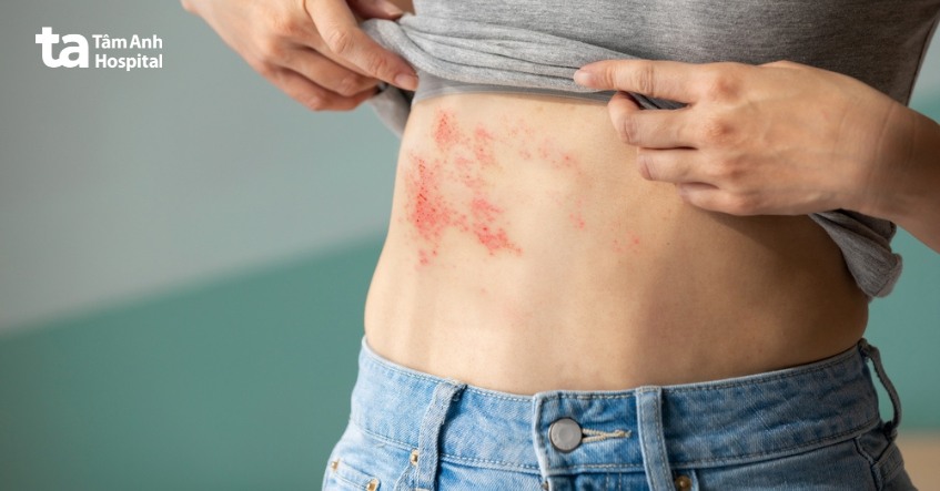 tùy mức độ bệnh zona gây ngứa khác nhau