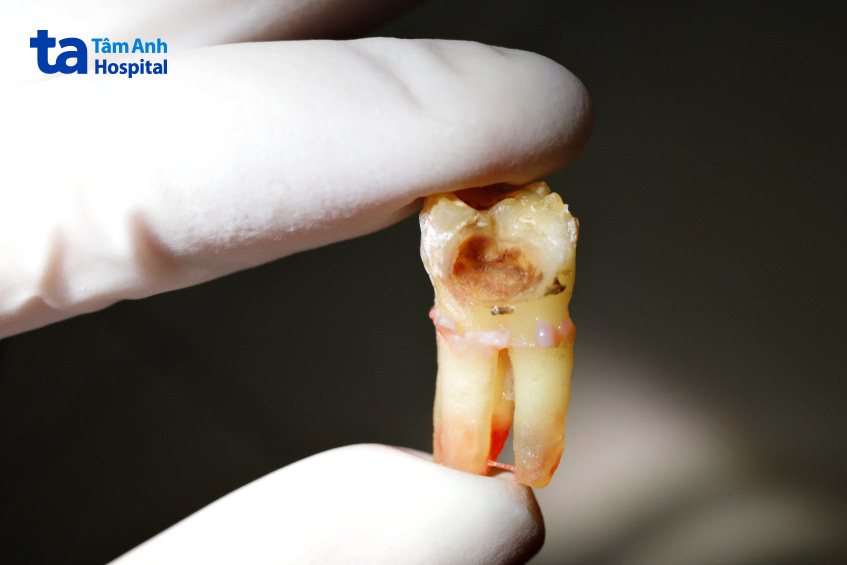 Các giai đoạn dẫn đến hoại tử tủy răng