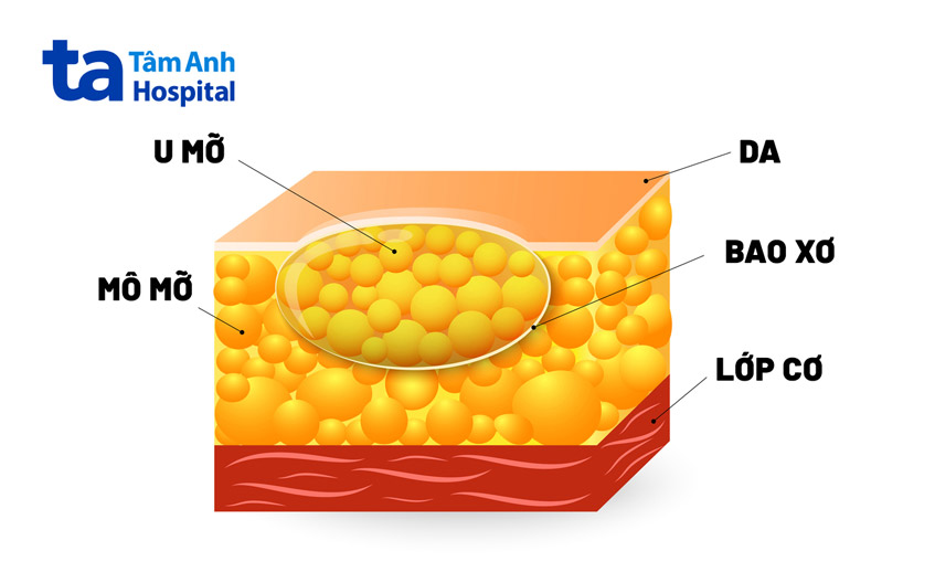 u mỡ là khối u lành tính