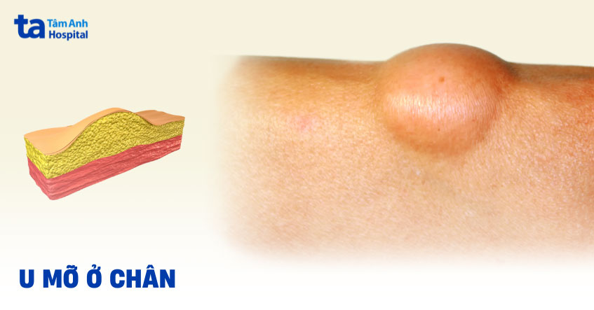 u mỡ ở chân