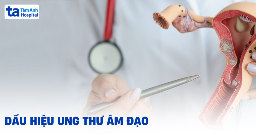 ung thư âm đạo