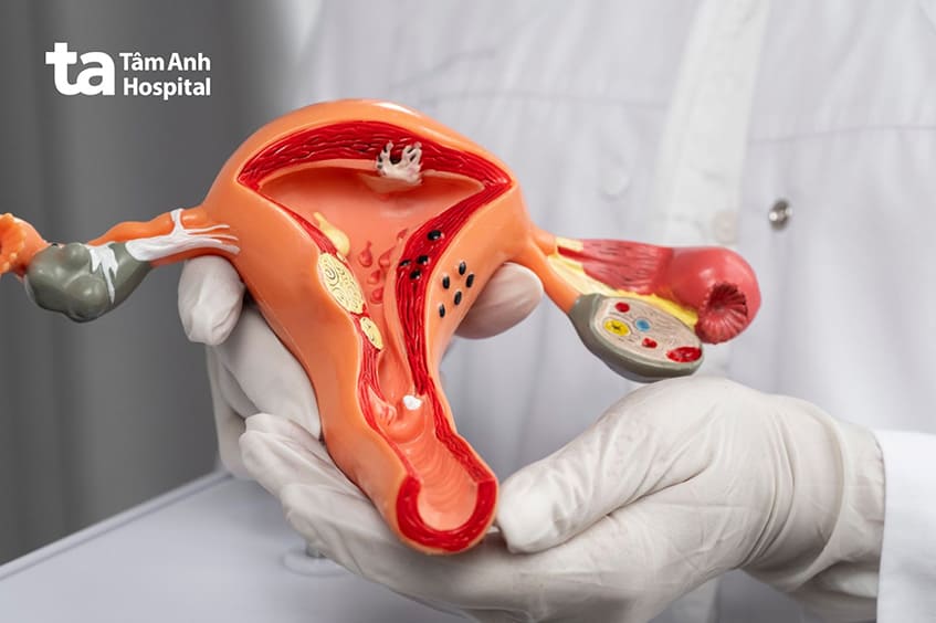 Ung thư cổ tử cung có thể gây chảy máu sau quan hệ tình dục