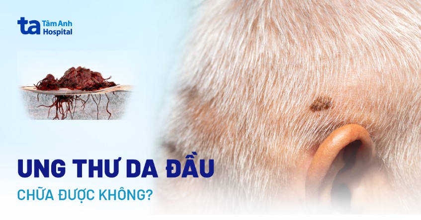 Ung thư da đầu có chữa được không? Yếu tố nào ảnh hưởng?