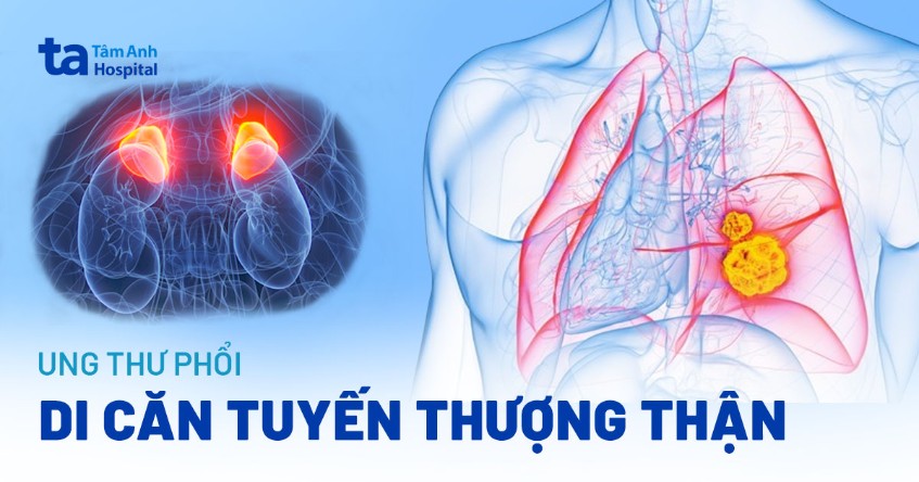 Ung thư phổi di căn tuyến thượng thận: Điều gì cần làm ngay?