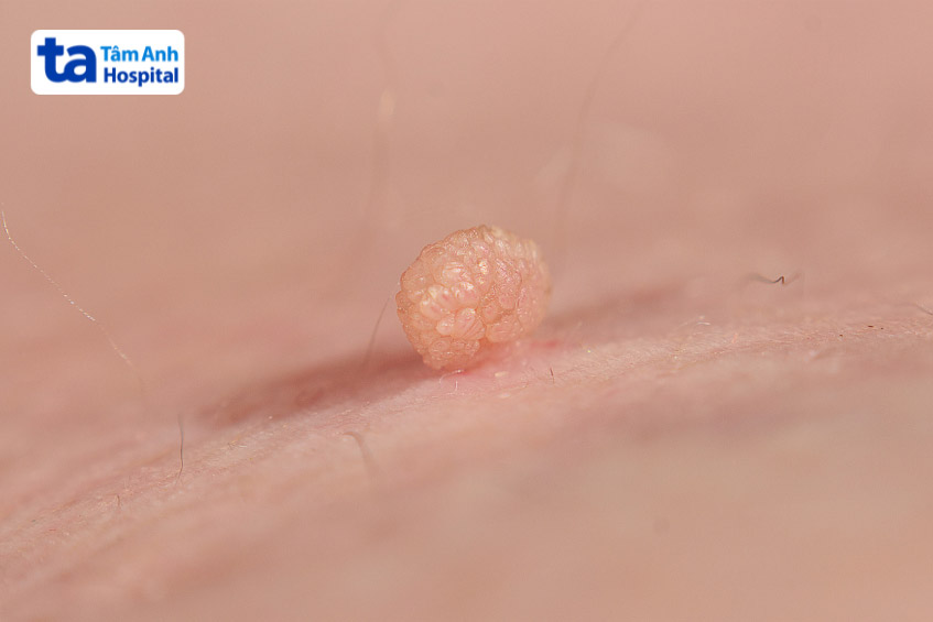 Vắc xin HPV phòng ngừa mụn cóc sinh lý