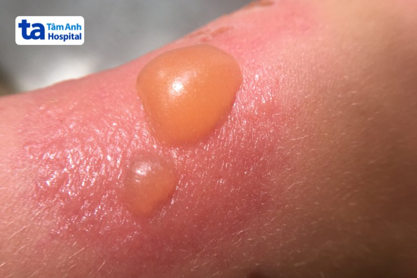 Vết bỏng nặng, xuất hiện bọng nước