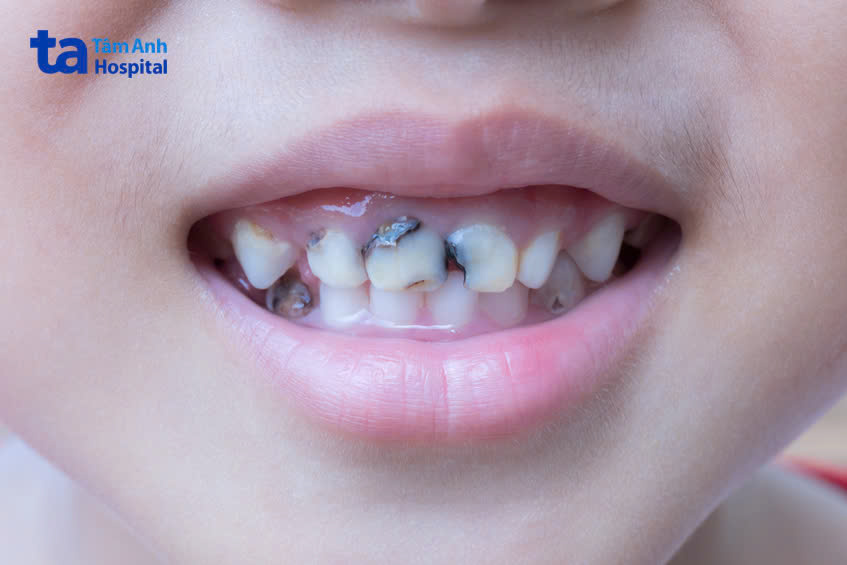 vết đen ở răng cửa