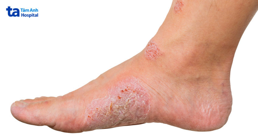 Viêm da cơ địa xuất hiện ở lòng bàn chân