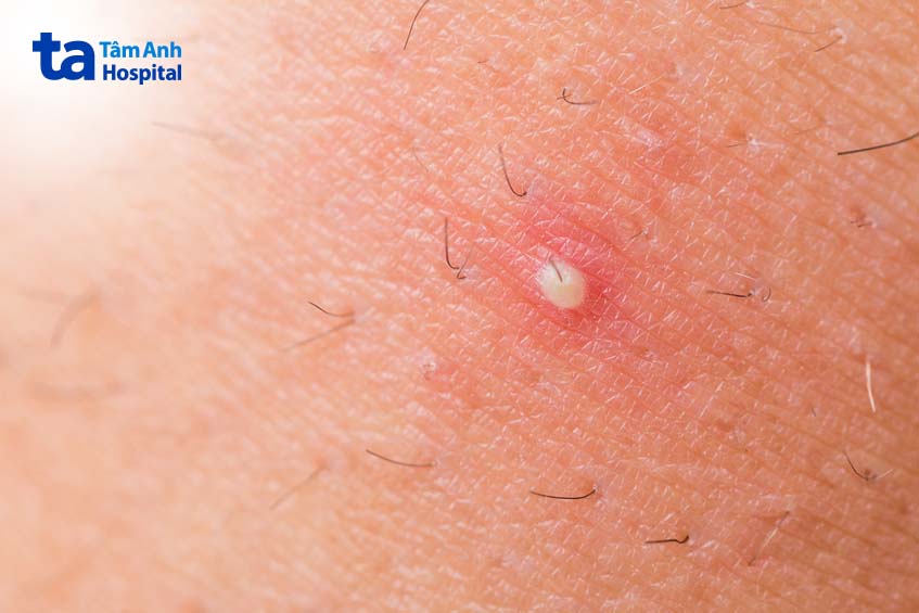 viêm nang lông phát triển thành mụn nhọt