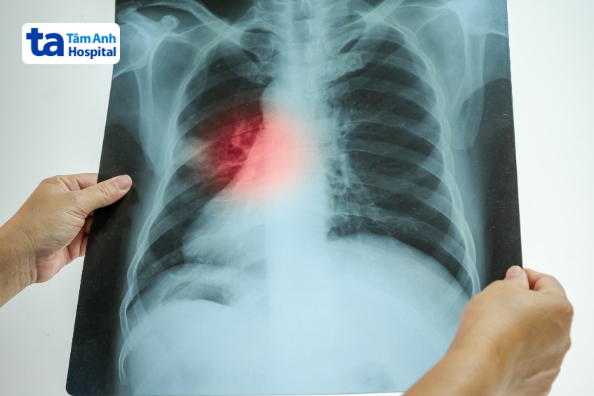 Viêm phổi cộng đồng được chẩn đoán dựa trên biểu hiện lâm sàng