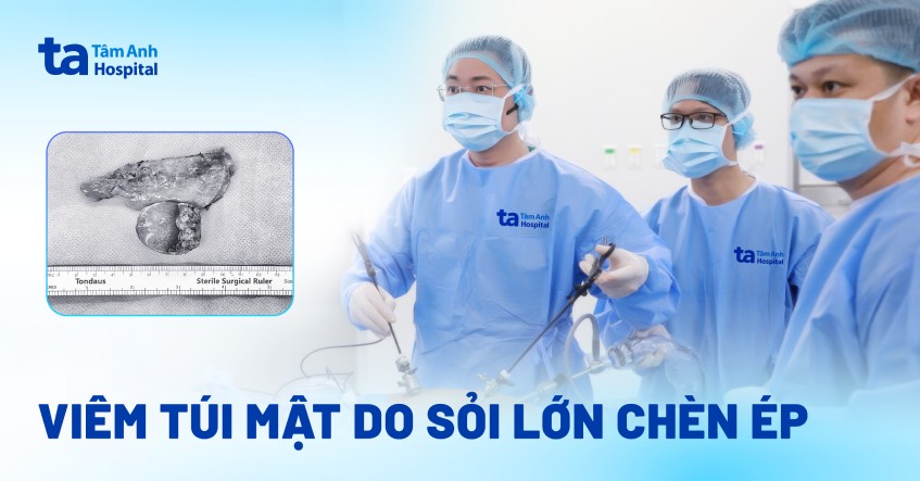 viêm túi mật do sỏi chèn ép