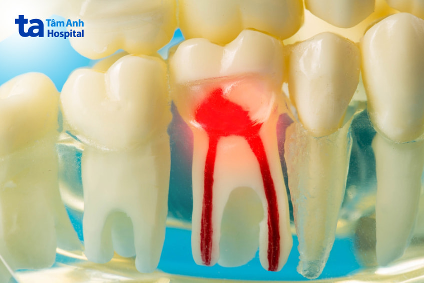 Dấu hiệu viêm tủy răng sữa