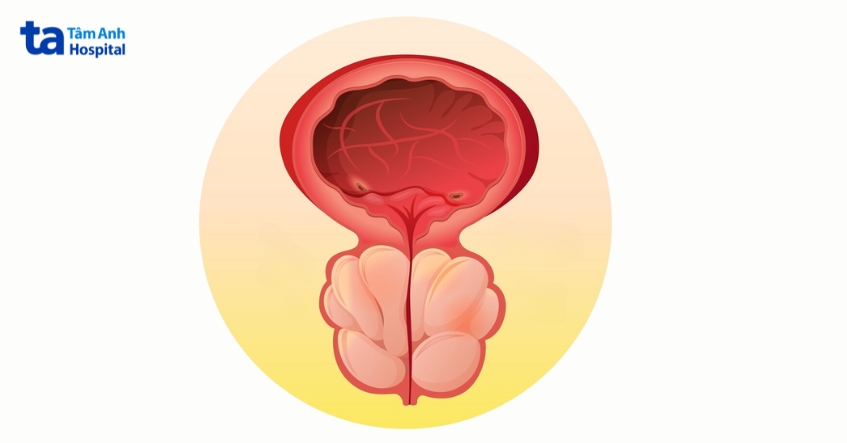 viêm tuyến tiền liệt gây chèn ép đường tiểu