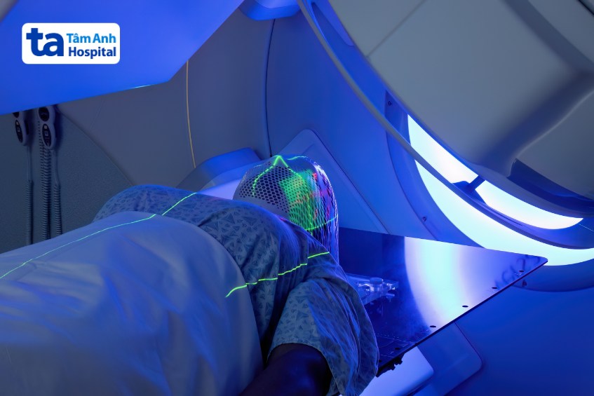 xạ trị khối u hốc mũi