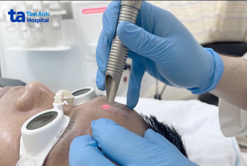xóa sẹo bằng laser tạo nhiệt