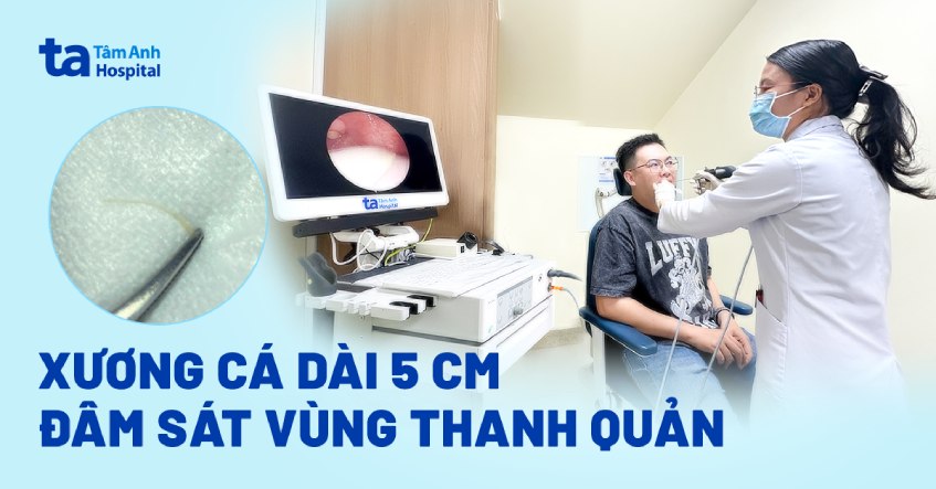 xương cá dài 5 cm đâm thanh quản