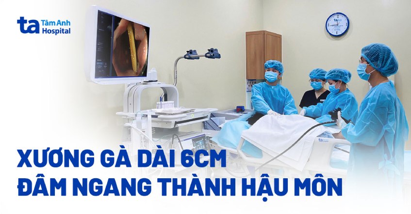 Xương gà dài 6 cm đâm ngang thành hậu môn