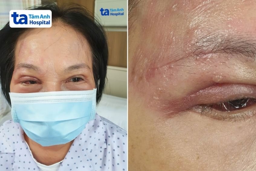 zona thần kinh tấn công vào mắt phải