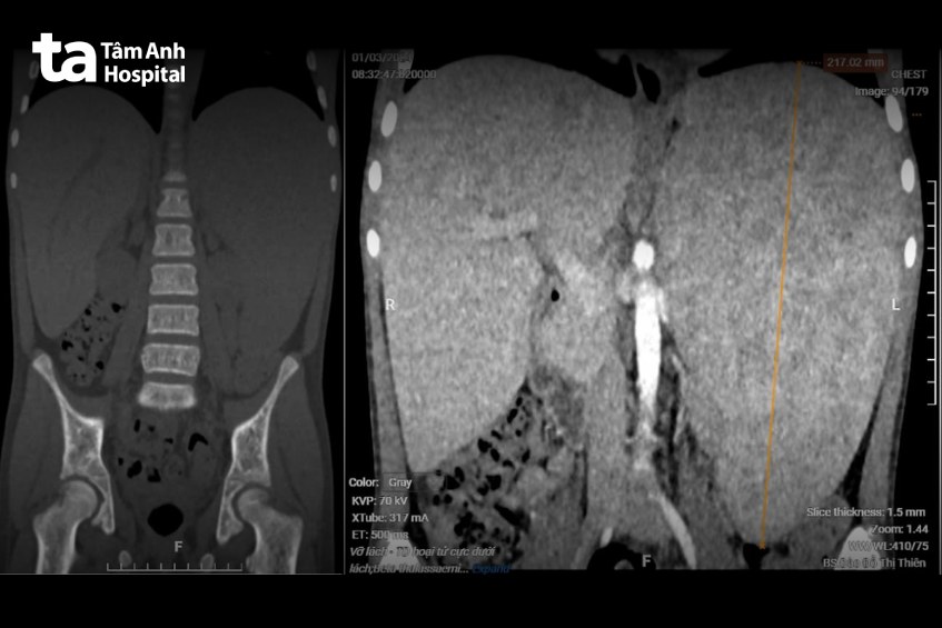 ảnh CT lách bị to
