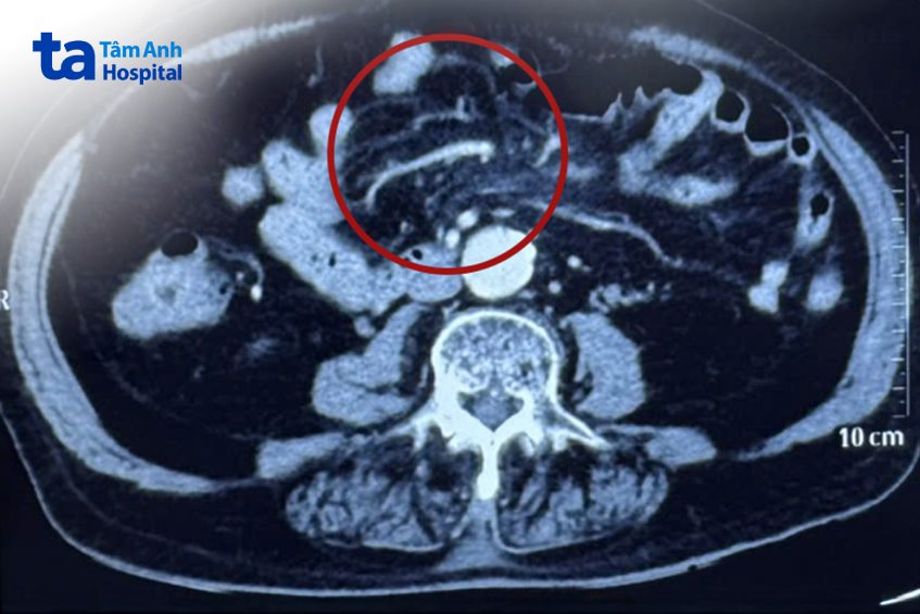 ảnh ct viêm mạc bị xơ hóa