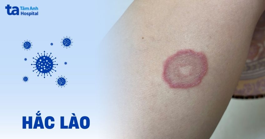 Bệnh hắc lào: Nguyên nhân, dấu hiệu, chẩn đoán và phòng tránh