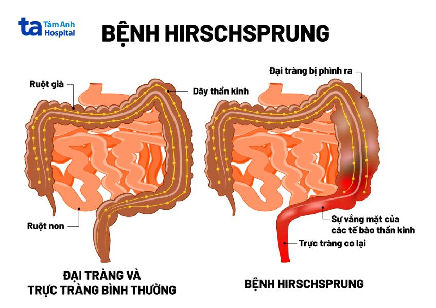 bệnh hirschsprung xảy ra do thiếu các tế bào thần kinh