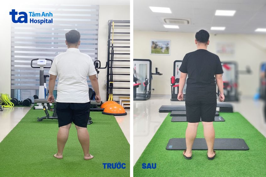 bệnh nhân trước và sau giảm cân