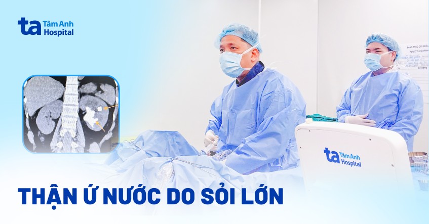Thận ứ nước do sỏi lớn