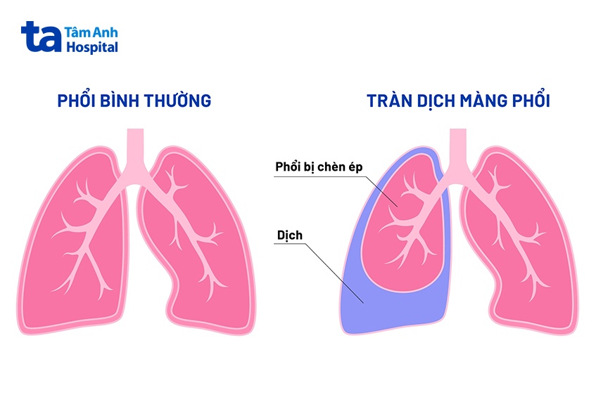 biến chứng tràn dịch màng phổi gây ảnh hưởng sức khỏe